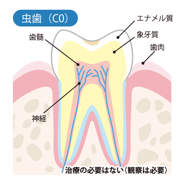 江北、豊島、東十条の歯科医院グループ、医療法人社団 医智会 医恵歯科医院で、むし歯治療