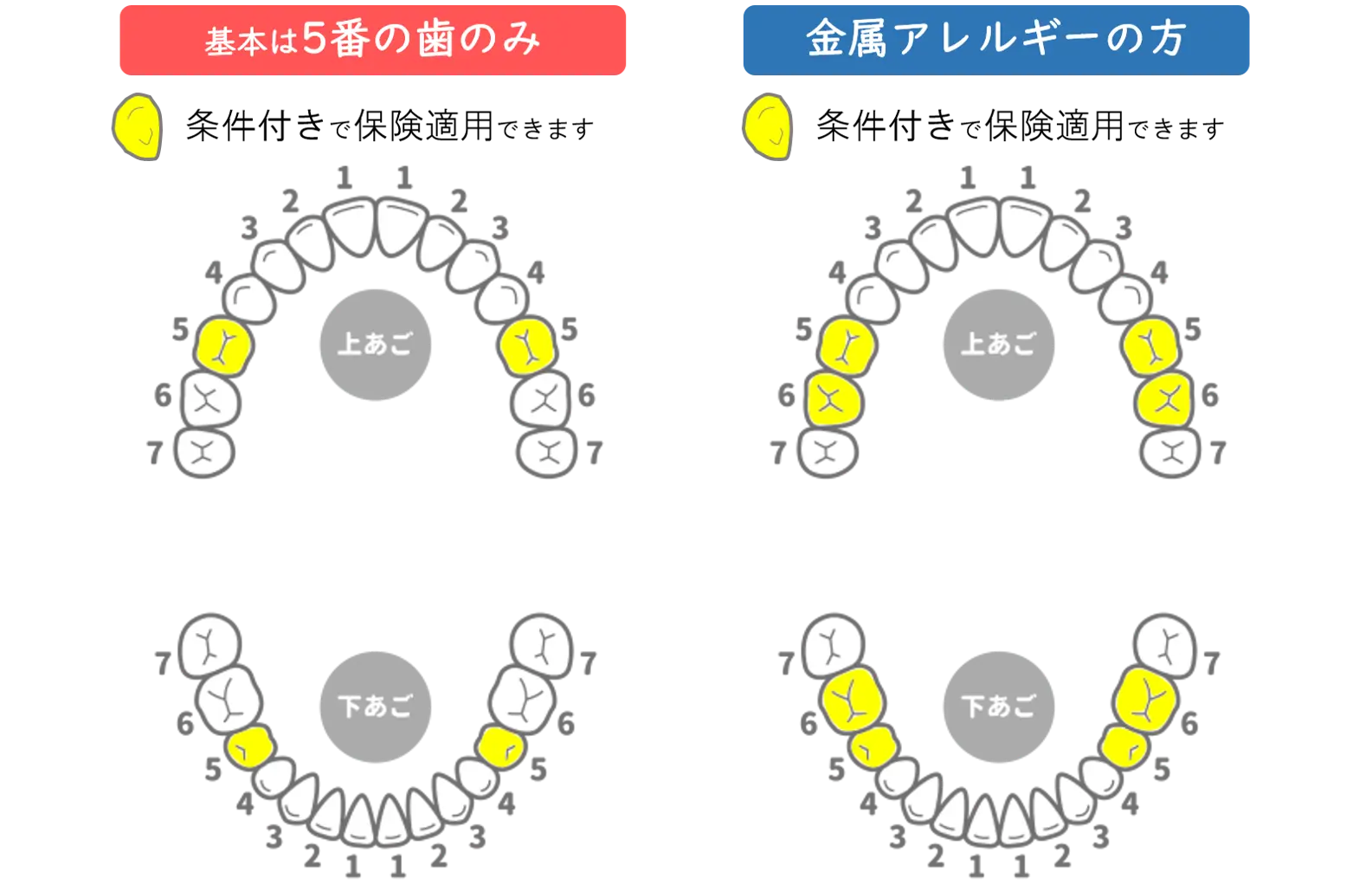 成瀬（町田市）の歯医者、シンシアメディカル歯科の保険適用の白い歯